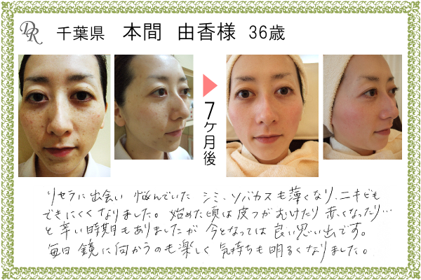 ドクターリセラ症例写真